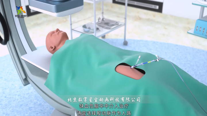 缺血性腦卒中